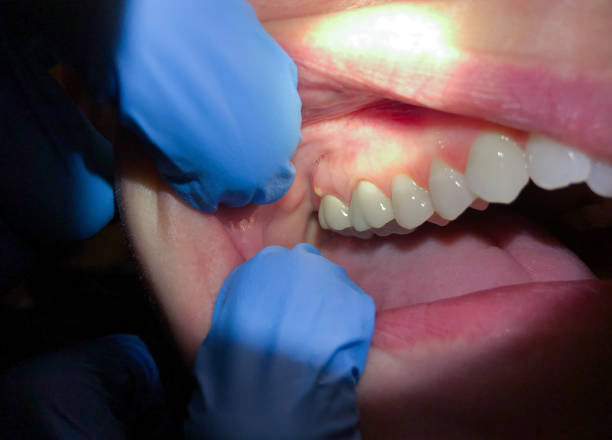 Best Emergency Treatment for Toothache in Glassport, PA